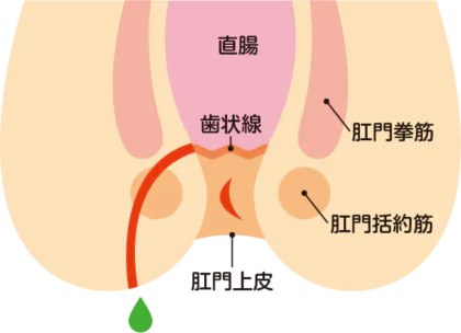 痔瘻（あな痔）