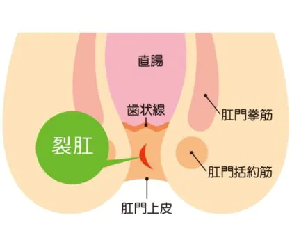 裂孔（切れ痔）