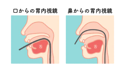 鼻からスコープを挿入する苦しくない「経鼻内視鏡検査」に対応