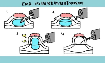 内視鏡的粘膜切除術（EMR;endoscopicmucosalresection）